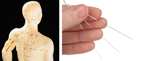 trigger point acupuncture
