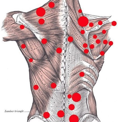 trigger point injection