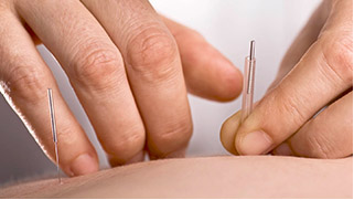 Acupuncture